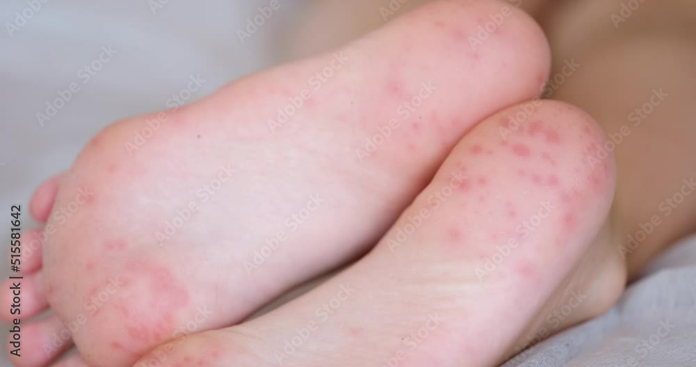 Feet of child with red allergic spots dots on foot Feet of child with red allergic spots dots on foot