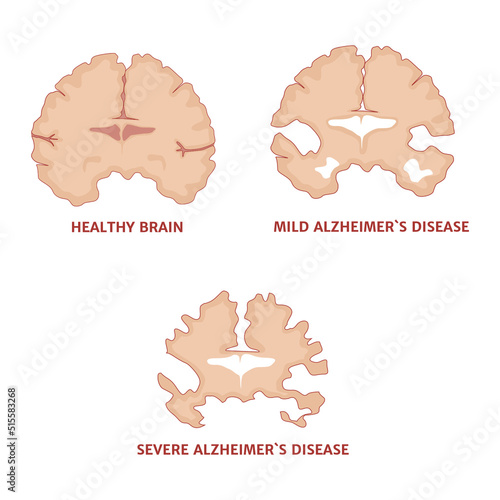 Alzheimer's disease. Stages of development of pathology with indication of the affected hippocampus. Medical poster. Vector illustration