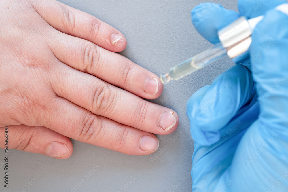 The doctor drips medicine from a pipette onto a finger. Close-up of a brush with nail fungus. Onycholysis: detachment of the nail from the nail bed The doctor drips medicine from a pipette onto a finger. Close-up of a brush with nail fungus. Onycholysis: detachment of the nail from the nail bed