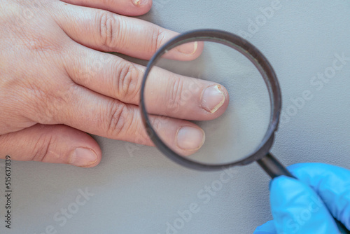 Onycholysis of woman's hands. The doctor examines a female patient with a problem of delamination of fingernails on a gray background photo