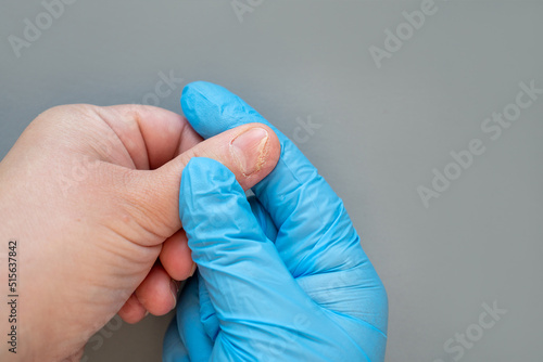 Onycholysis of woman's hands. The doctor examines a female patient with a problem of delamination of fingernails on a gray background photo
