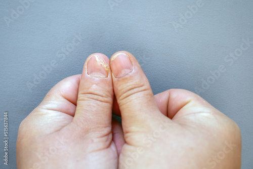 Close-up of thumb with fungus on a gray background. Onycholysis: detachment of the nail from the nail bed. photo