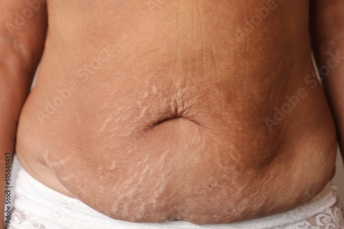 Fotografie Close up of woman's belly with stretch mark loose lower abdomen skin she fat after pregnancy baby birth, studio isolated, unhealthy belly overweight excess body concept