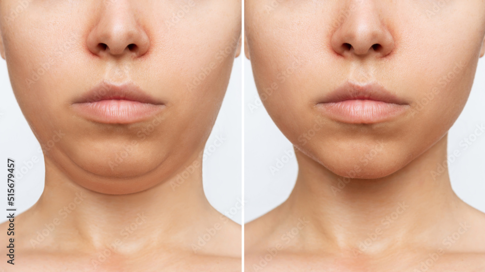 Liposuction of the double chin. Cropped shot of a woman's face with chin before and after cosmetic plastic surgery isolated on a white background. The result of lifting, fat removal, weight loss - obrazy, fototapety, plakaty 