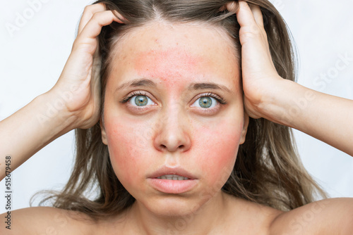 A young caucasian worried woman with a red allergic rash on her cheeks and forehead isolated on white background. Allergy on the face. Allergic reaction to food, cosmetics, medicines 