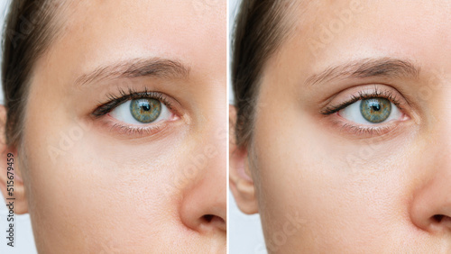 Canvas Print Cropped shot of a young caucasian woman's face with drooping upper eyelid before and after blepharoplasty isolated on white background