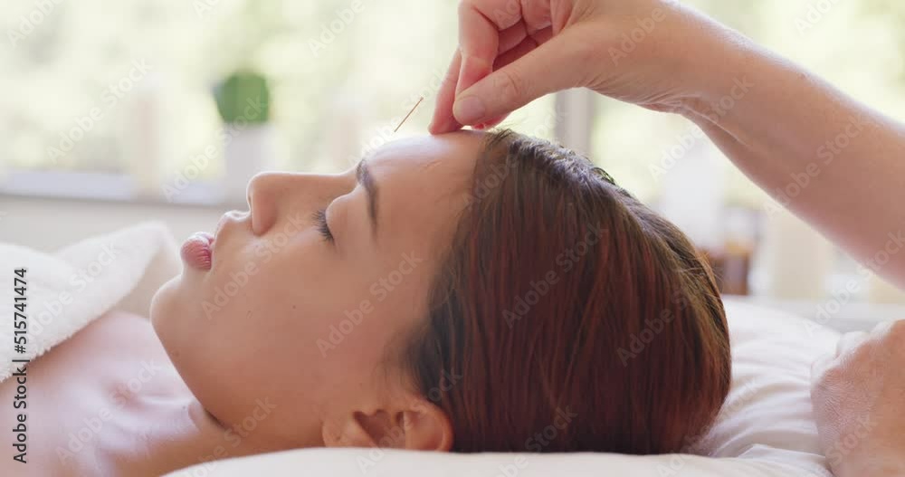 Beautician or masseuse placing acupuncture needles into forehead of female client. Closeup of a woman having anti aging dry needling done to her face. Young woman lying on a beauty spa massage table Beautician or masseuse placing acupuncture needles into forehead of female client. Closeup of a woman having anti aging dry needling done to her face. Young woman lying on a beauty spa massage table