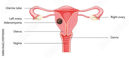 Adenomyoma Adenomyosis with inscriptions, Human anatomy Female reproductive Sick system organs. Structure of uterus, cervix, ovary, fallopian tube in Latin text. Frontal view Vector illustration