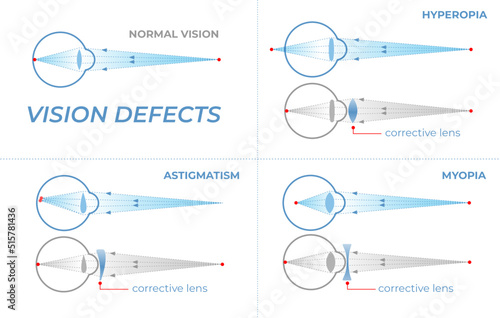 Vision defects and their correction with intraocular lenses. Vision problems with hyperopia, myopia and astigmatism. Section of an eye for ophthalmologist infographics photo