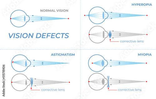 Vision defects and their correction with intraocular lenses. Vision problems with hyperopia, myopia and astigmatism. Section of an eye for ophthalmologist infographics