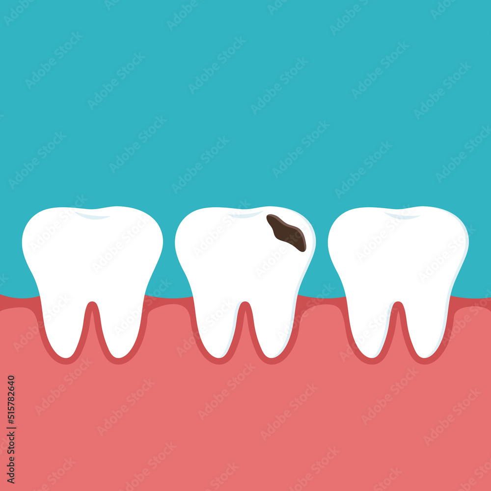 Vector dental medical illustration of a healthy tooth and a tooth with decay and a gum hole. Vector dental medical illustration of a healthy tooth and a tooth with decay and a gum hole.