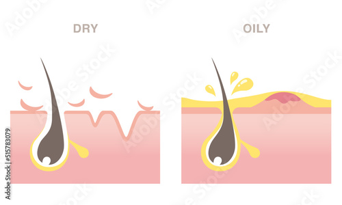Skin cross section of pore types. Acne on oily skin, wrinkles on dry skin. Pale colored illustration in flat cartoon style.