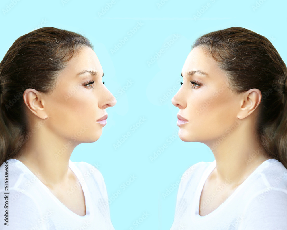 face beauty, nose and chin correction, rhinoplasty, genioplasty,Chin augmentation face beauty, nose and chin correction, rhinoplasty, genioplasty,Chin augmentation