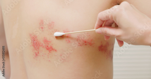 Tableau sur toile man with shingles disease