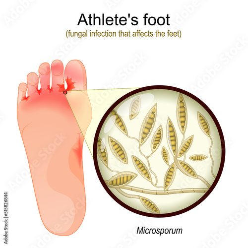 Athlete's foot. fungal infection that affects the feet.
