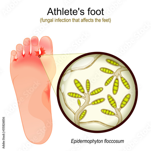 Athlete's foot. fungal infection that affects the feet.