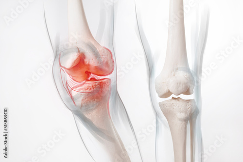 Human leg, knee meniscus, medically accurate representation of an arthritic knee joint