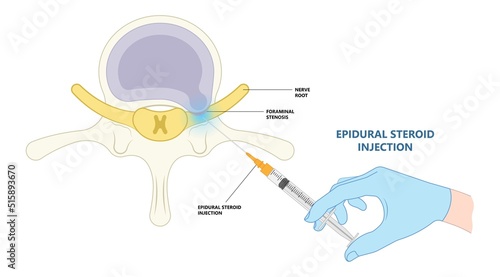 physical therapy spine cord hernia anatomy neck Bone Paget’s facet pain anti inflammatory drugs back hip lumbar root lower canal spurs local disk neural heavy space good poor bad neural nerve block