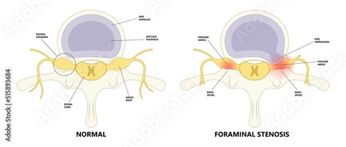 anti inflammatory drugs spine back hip pain lumbar Bone root lower canal physical therapy spurs local neck disk neural hernia heavy Paget’s facet space good poor bad neural cord nerve block anatomy