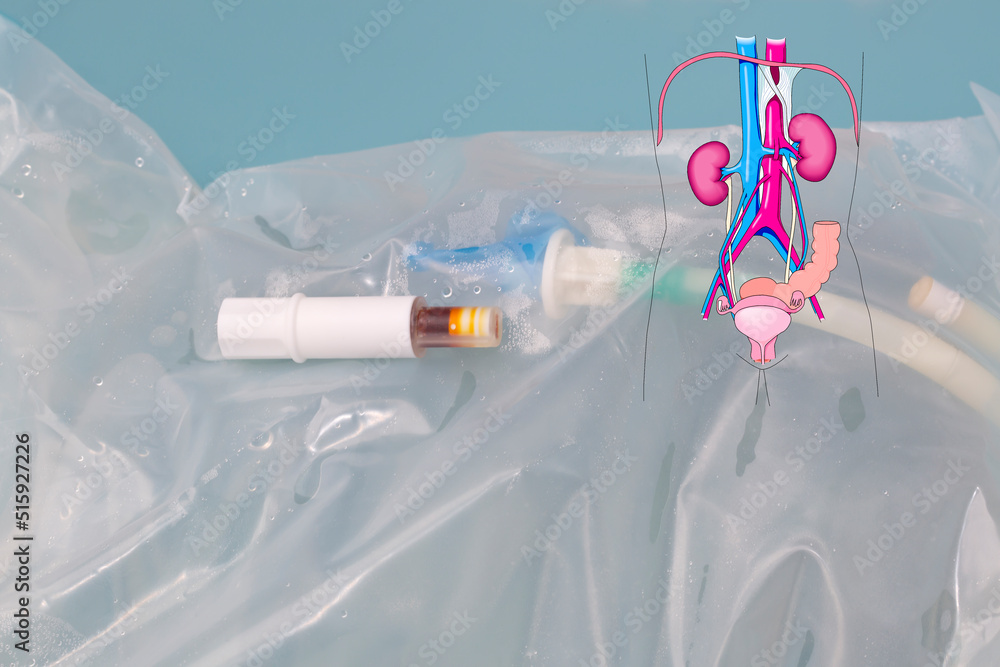 Continuous ambulatory peritoneal dialysis concept. Schematic