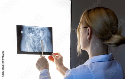 Osteotomy of the femur. A female doctor examines an X-ray before an operation. photo