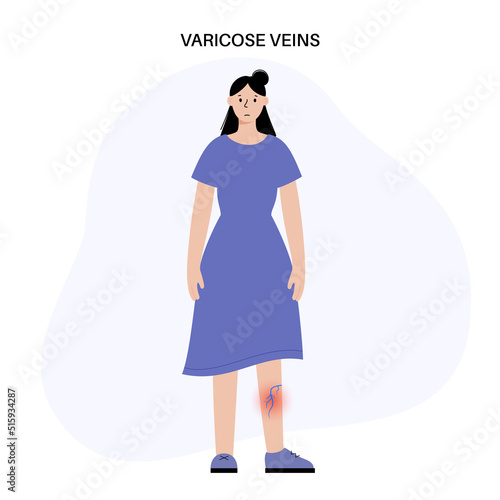 Varicose veins treatment