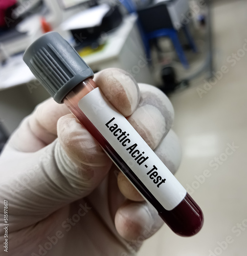 Obraz na plátně Blood sample for Lactic acid test, to diagnosis inadequate amount of oxygen in cells and tissues (hypoxia), plasma Lactate test
