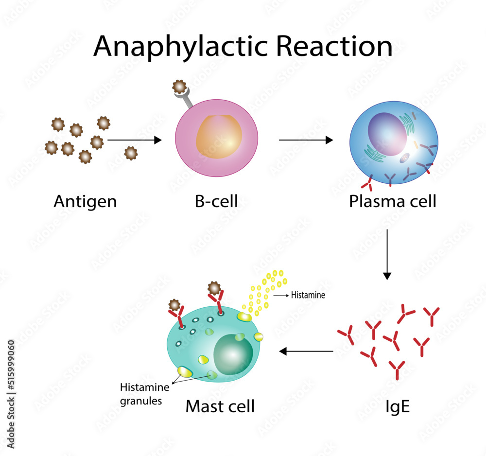 Anaphylactic Reaction Allergic Reaction Autoimmune Disorders Allergy And Anaphylaxis Mast