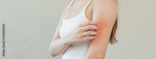 Photos Dermatology, asian young woman, girl allergy, allergic reaction from atopic, insect bites on her arm, hand in scratching itchy, itch red spot or rash of skin