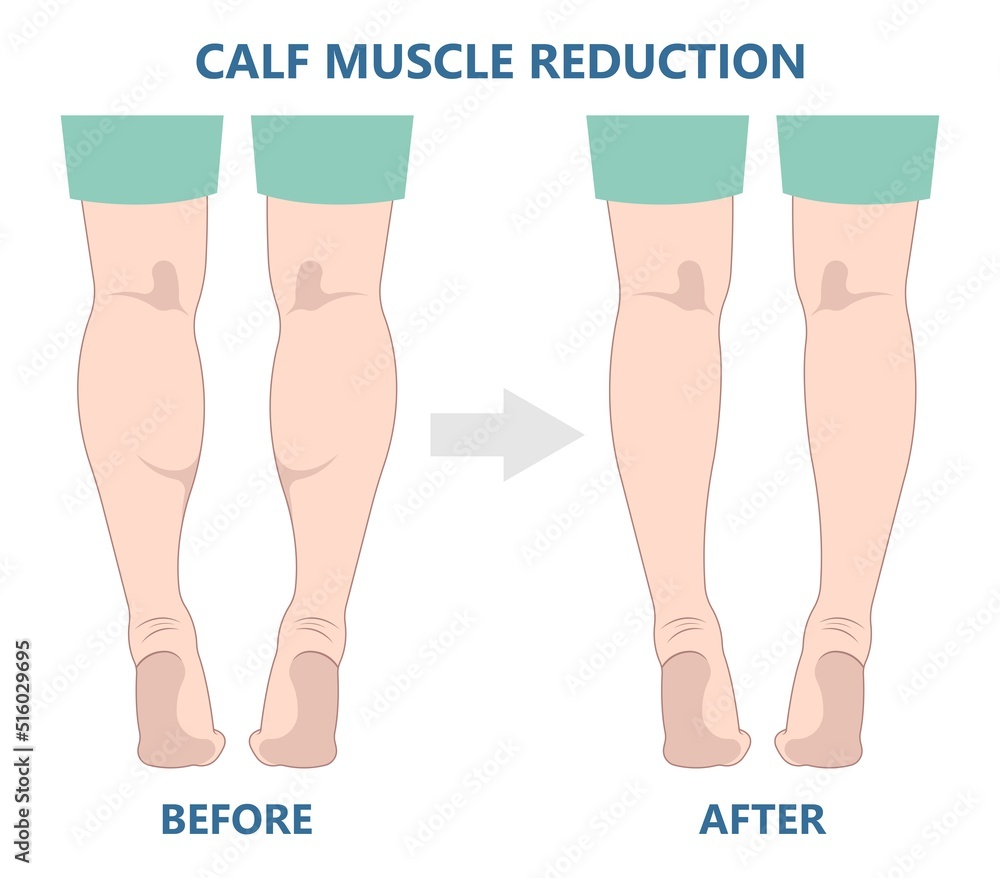 reduce-slim-leg-size-fat-grafting-transfer-ankle-beauty-care-lift