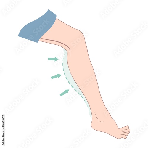 women calf reduce slim leg size deformity lose fat Gel lift resection gastrocnemius neurectomy reshapes ankle beauty body care female fitness treat polio grafting transfer Filler pain male toxin limb