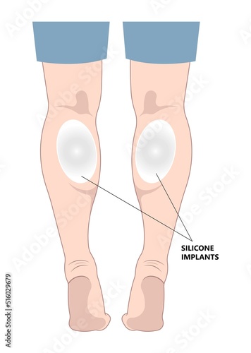 gastrocnemius lift resection male women reshapes body calf reduce slim leg size deformity lose fat Gel neurectomy ankle beauty care female fitness treat polio grafting transfer Filler pain toxin limb