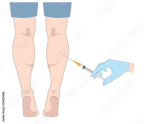 fat grafting transfer ankle beauty care lift resection male women reshapes body calf reduce slim leg size deformity lose Gel neurectomy female fitness treat polio Filler pain toxin limb gastrocnemius