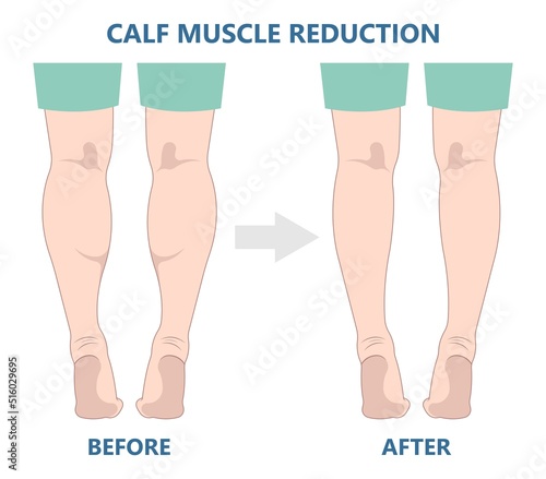 reduce slim leg size fat grafting transfer ankle beauty care lift resection male women reshapes body calf deformity lose Gel neurectomy female fitness treat polio Filler pain toxin limb gastrocnemius