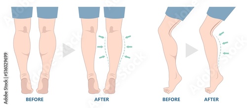 polio leg calf resection deformity reduce slim size fat grafting transfer ankle beauty care lift male women reshapes body lose Gel neurectomy female fitness treat Filler pain toxin limb gastrocnemius