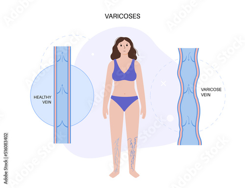 Varicose veins treatment