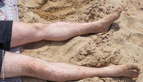 A sunbathing adult man lies on the sand with pale legs with red patches of psoriasis. Skin disease with psoriatic ulcers photo