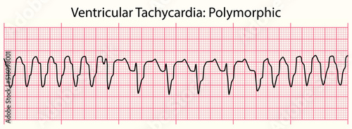 ECG line: Ventricular Tachycardia Polymorphic in 6 second ECG paper line