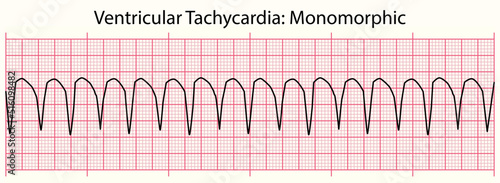 ECG line: Ventricular Tachycardia Monomorphic in 6 second ECG paper line