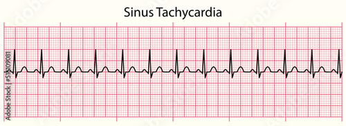 ECG line: Sinus Tachycardia in 6 second ECG paper line