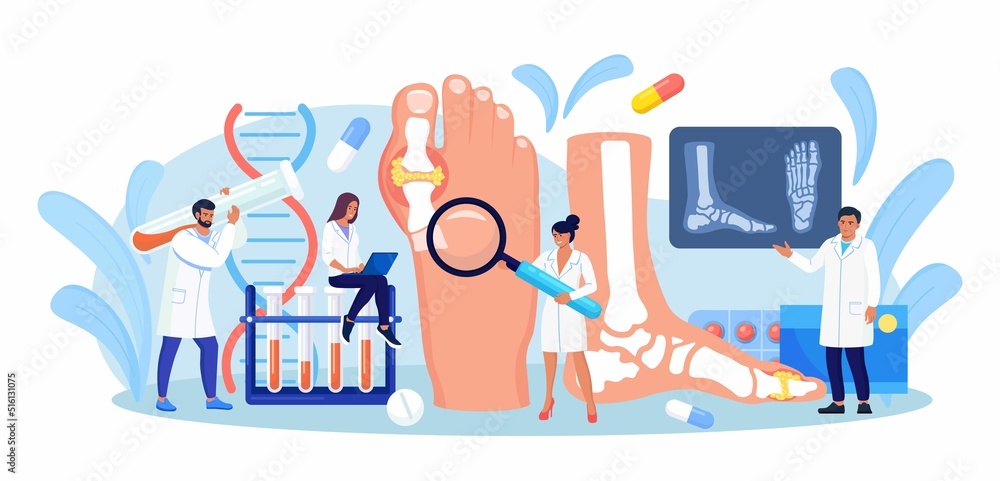 Gout treatment. Arthritis joint in the ankle. Doctor diagnoses swollen and inflamed foot joint. Physician looking at x-ray scan. Human feet bone with uric acid crystals. Medical appointment and exam