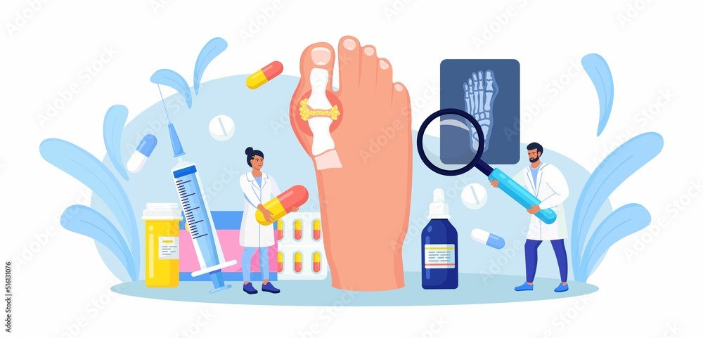 Gout treatment. Arthritis joint in the ankle. Doctor diagnoses swollen and inflamed foot joint. Physician looking at x-ray scan. Human feet bone with uric acid crystals. Medical appointment and exam Gout treatment. Arthritis joint in the ankle. Doctor diagnoses swollen and inflamed foot joint. Physician looking at x-ray scan. Human feet bone with uric acid crystals. Medical appointment and exam