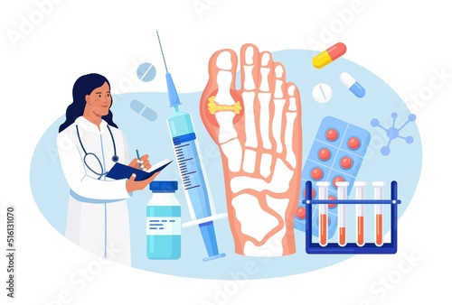 Gout treatment. Arthritis joint in the ankle. Doctor diagnoses swollen and inflamed foot joint. Physician examination human feet bone with uric acid crystals. Medical appointment and exam