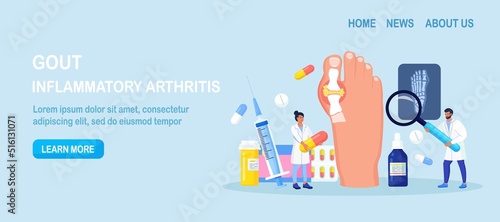 Gout treatment. Arthritis joint in the ankle. Doctor diagnoses swollen and inflamed foot joint. Physician looking at x-ray scan. Human feet bone with uric acid crystals. Medical appointment and exam