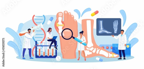 Gout treatment. Arthritis joint in the ankle. Doctor diagnoses swollen and inflamed foot joint. Physician looking at x-ray scan. Human feet bone with uric acid crystals. Medical appointment and exam