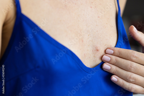 Abscess on the chest of a woman. Closeup, selective focus.