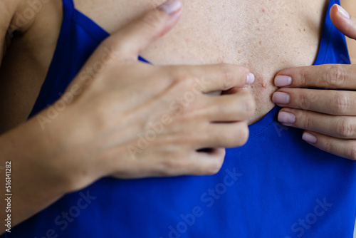 Girl squeezes pimple on her chest. Closeup. Selective focus. Healthcare and medicine concept. © Vitalina