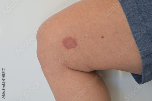 Obraz na plátně A Horsefly bite on a Ladies leg.