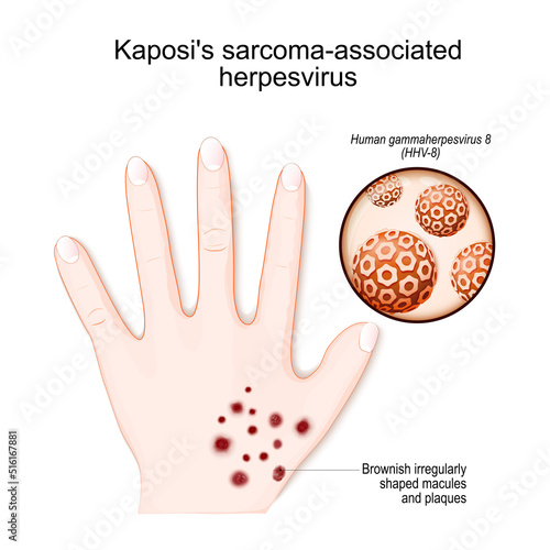 Kaposi's sarcoma-associated herpesvirus. Human's hand