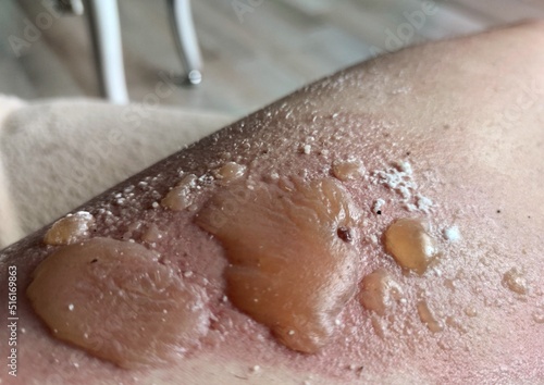 Leg burn. Large blisters when burning the body with boiling water, steam. Dropsy from a burn.